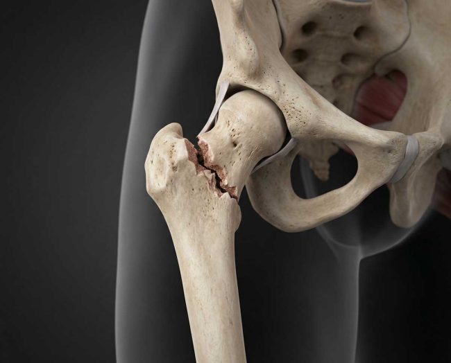 Prelom-butne-kosti Ilustracija preloma butne kosti