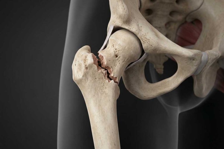 Ilustracija preloma butne kosti